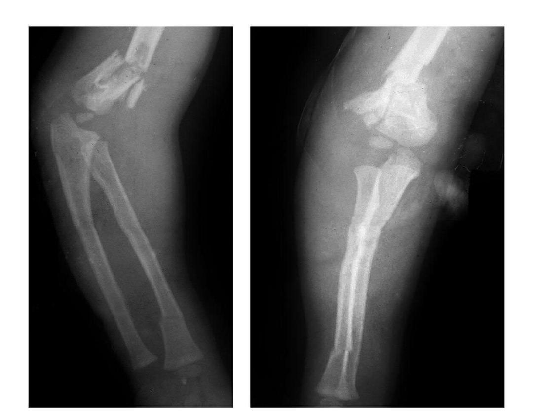 青少年肘部损伤最常见的是,肘部桡神经损伤的临床表现