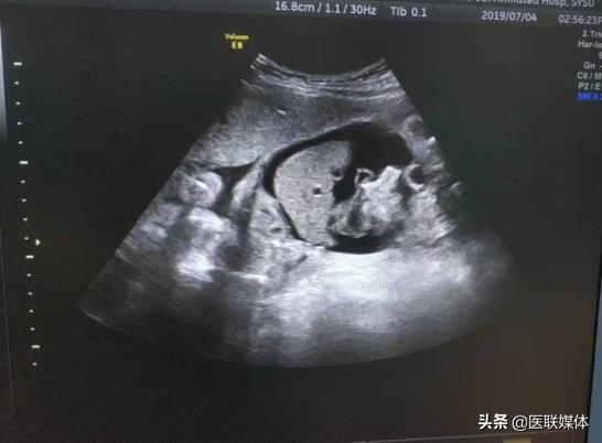 怀孕查出稀有血型,孕妈是稀有血型