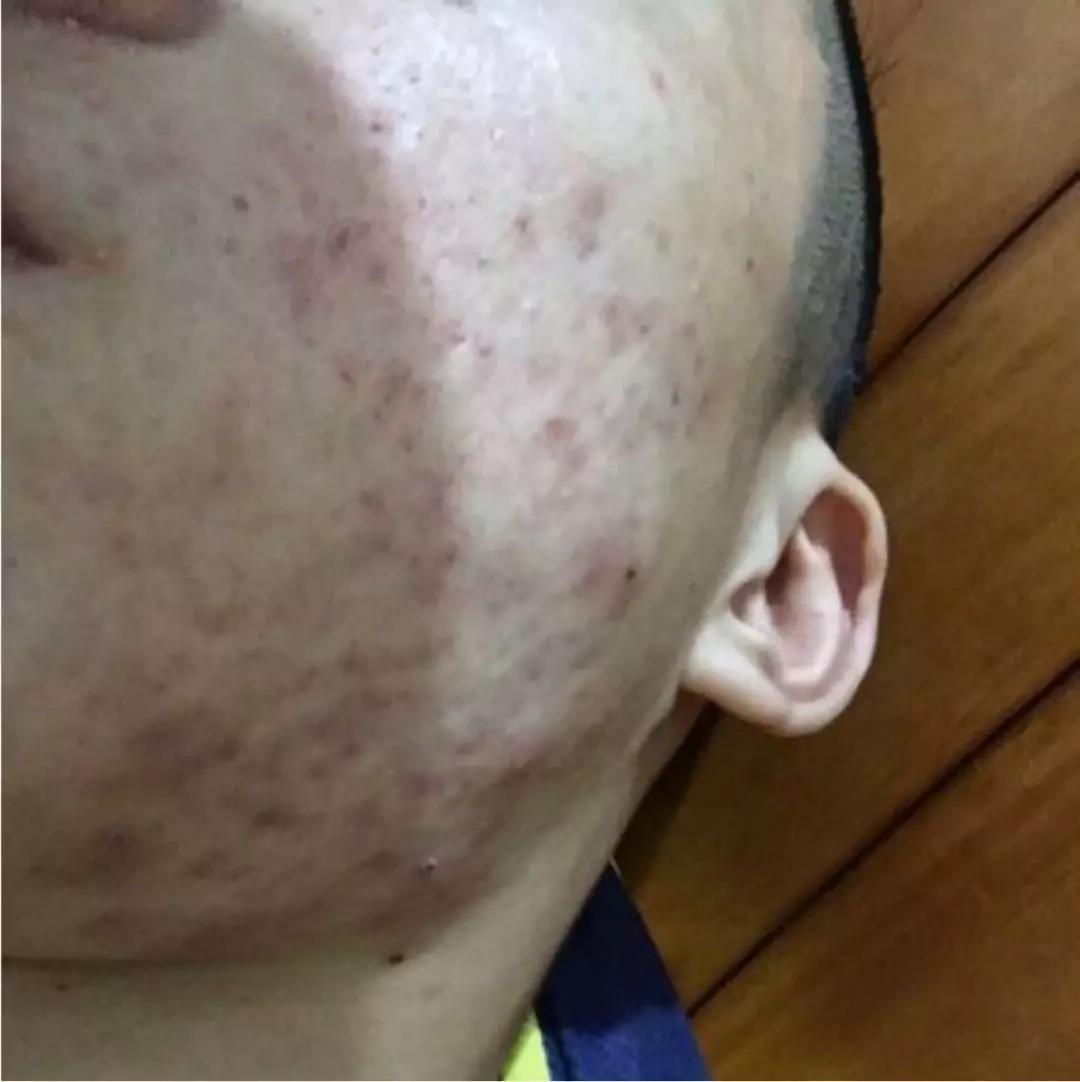 祛痘印的方法怎么可以快速祛痘印,怎样有效快速祛痘祛痘印