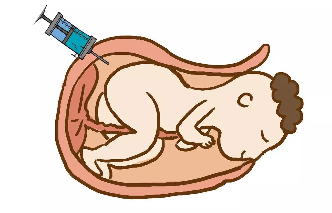 唐氏儿鼻骨是缺失还是发育不良,20周胎儿一侧鼻骨缺失或发育不良