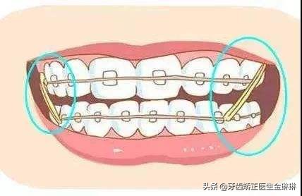 19岁蛀牙牙不齐矫正多久,牙齿拥挤有蛀牙怎么补救