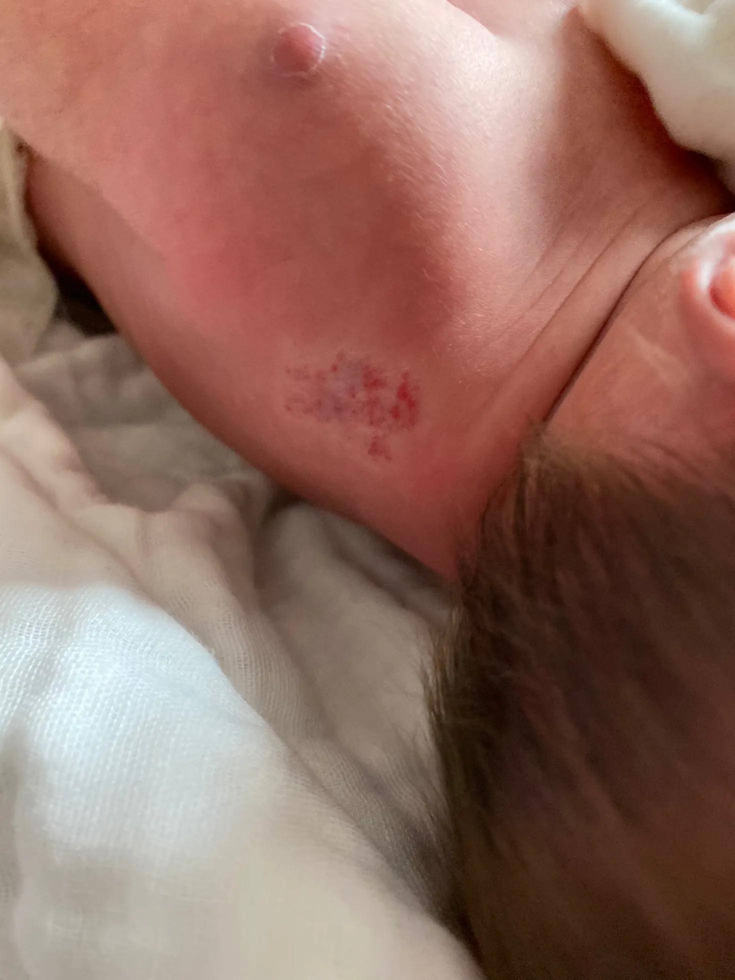 宝宝血管瘤用眼药水以后1个月淡化好多（带图）