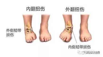 关节扭伤为什么要制动,踝关节扭伤石膏外固定方法