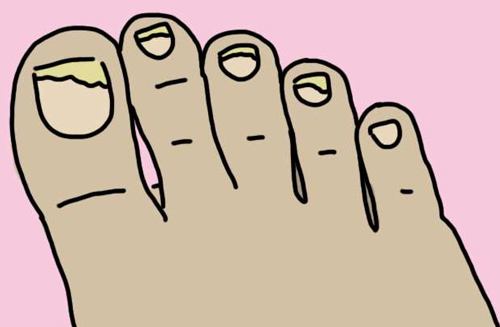 得了灰指甲别着急简单方法教给你,轻松告别灰指甲的方法