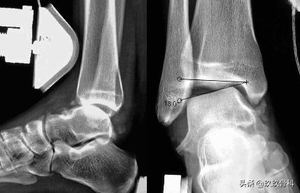 陈旧性踝关节损伤的治疗,踝关节损伤现场处理视频