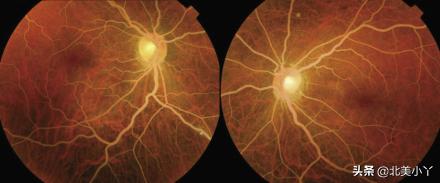 如何防治高脂血症,青少年如何预防高脂血症