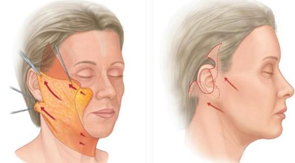 大拉皮术后50天真实感受,拉皮手术5年之后的变化