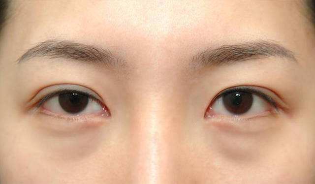 去眼袋整形失败案例,科普整形科去眼袋