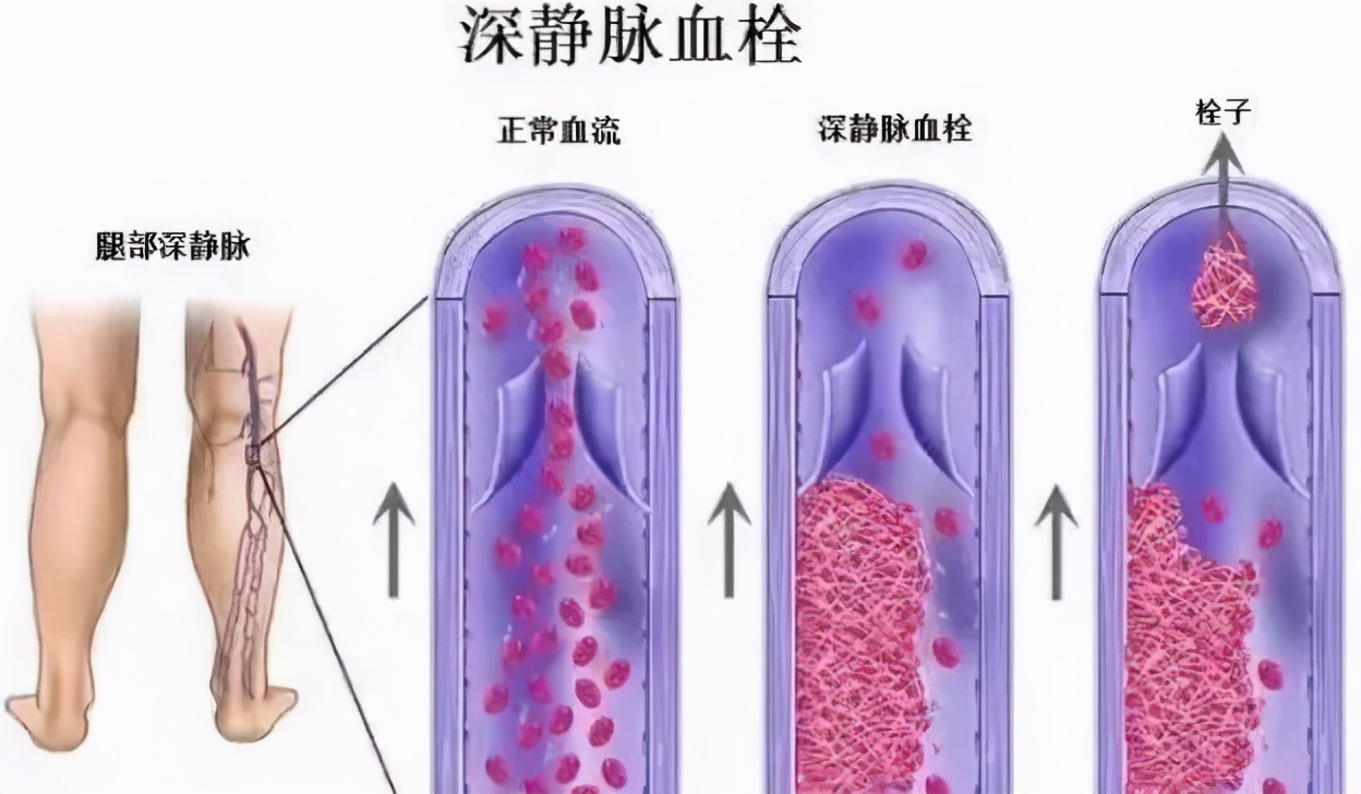 静脉血管堵怎么治疗,小隐静脉血栓处理