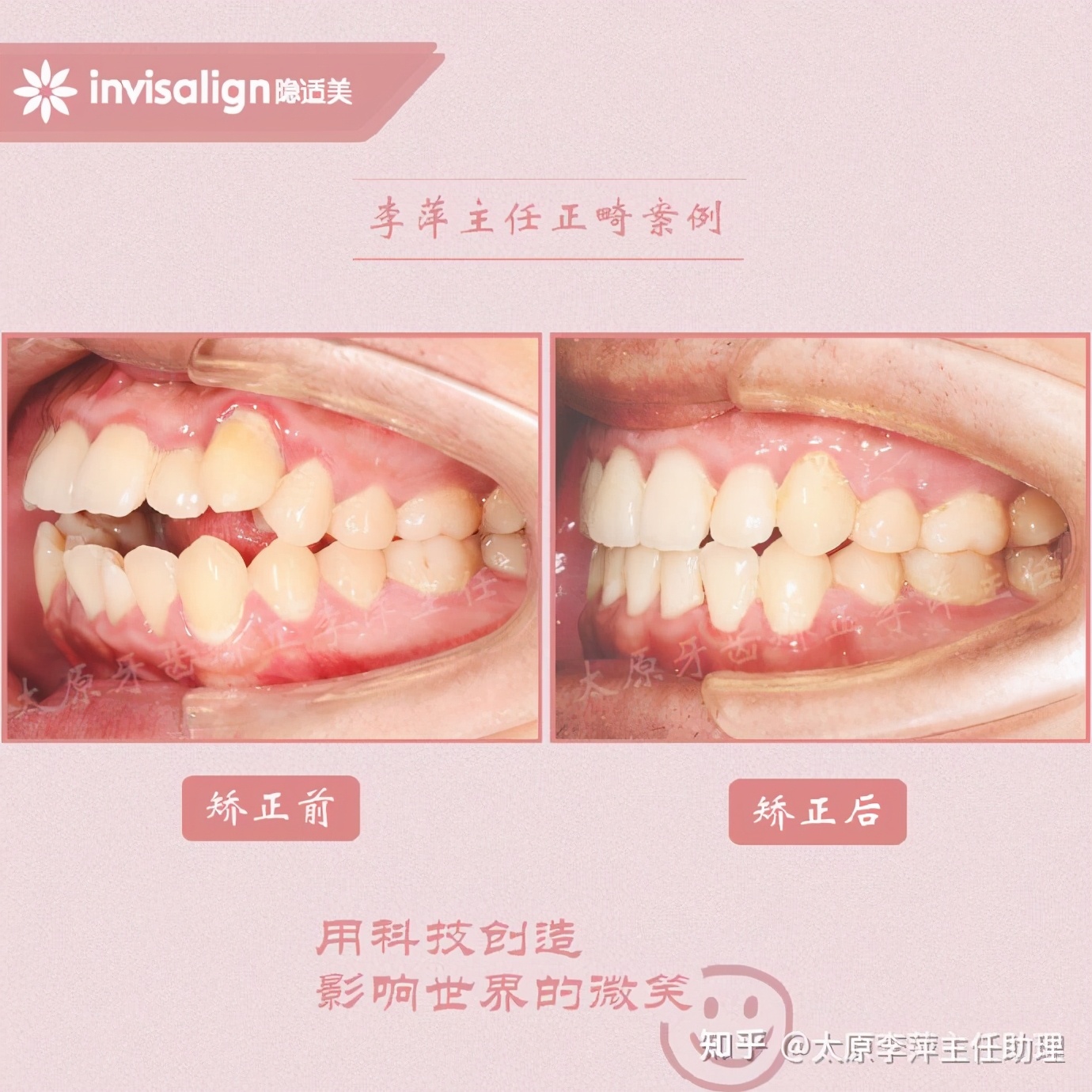 太原矫正牙齿需要做正颌吗,太原牙齿二次矫正