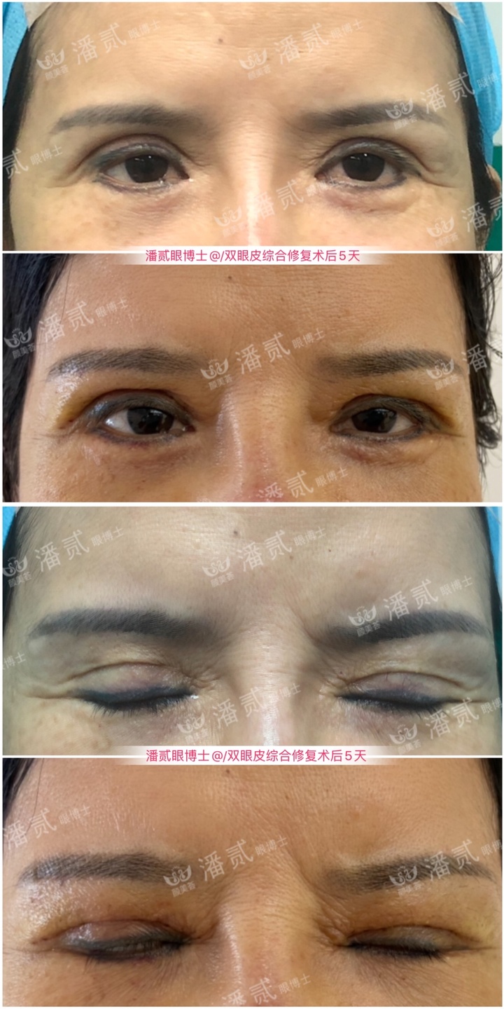 割双眼皮眼皮压下来会恢复吗,割双眼皮以后会松弛更快吗