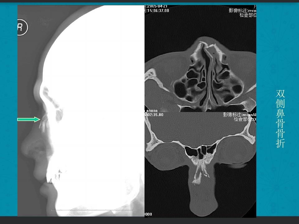 鼻骨骨折复位全过程,诊断证明鼻骨骨折问号是什么意思