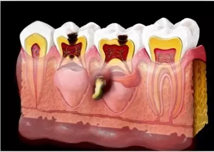 小孩乳牙坏了会影响以后的恒牙么,宝宝牙齿烂了怎么办最快最有效