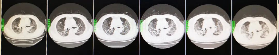 先后7次不同标本核酸检测皆为阴性，但血液中抗体出现动态升高