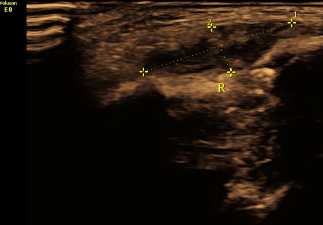 八个月大宝宝锁骨断了,新生儿锁骨断了错位