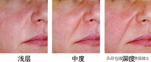这3种方法解决法令纹效果很惊艳,最有效改善法令纹的方法