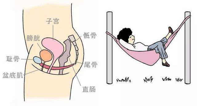 生过孩子的女人,很多都会脱垂、漏尿,怎么办?