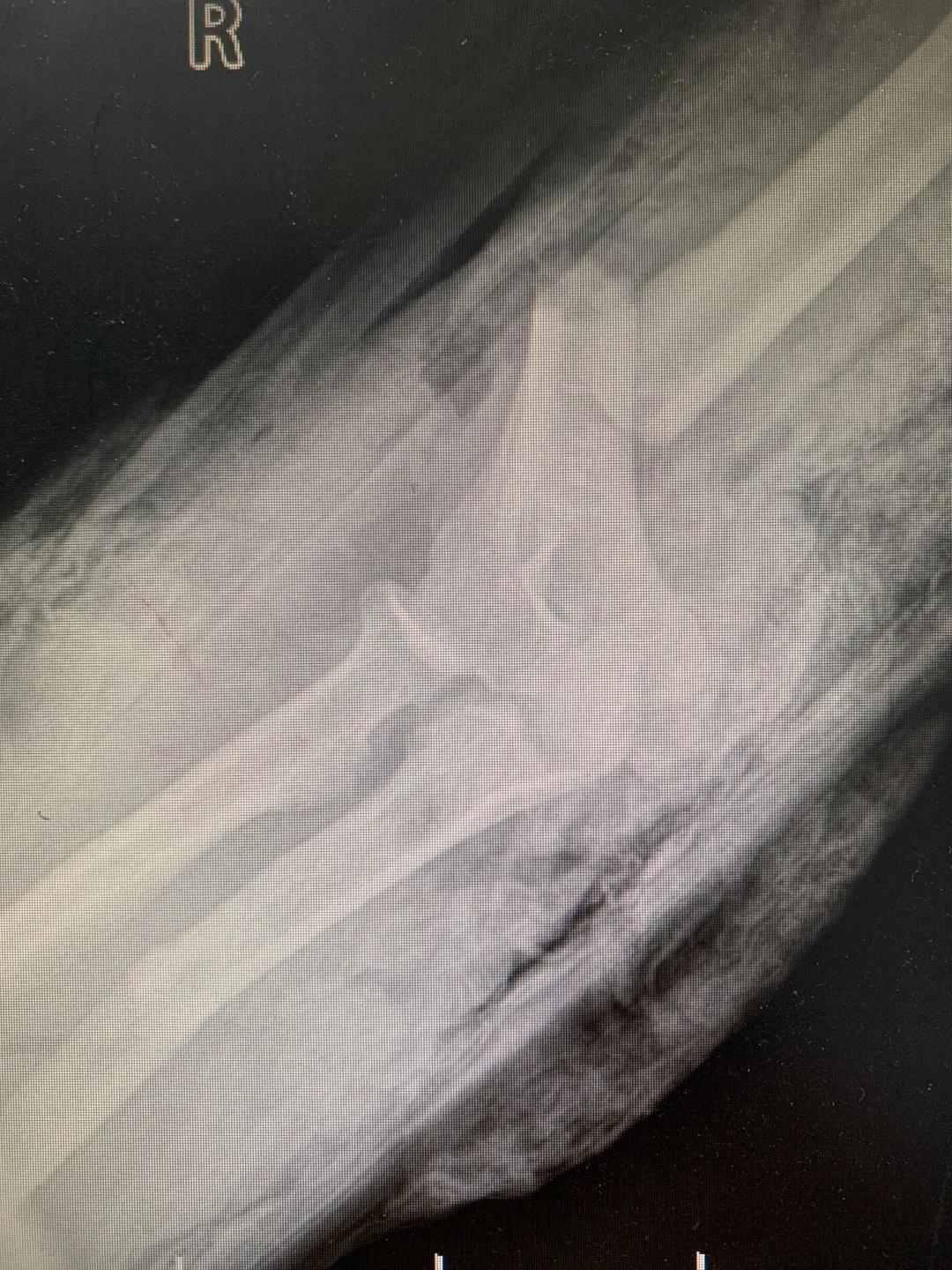 【日照市人民医院】右臂卷入机器被撕裂　6.5小时成功复活