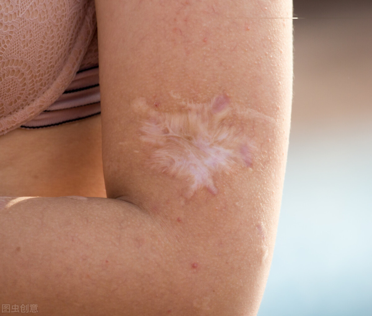 开水烫伤用什么涂一涂,香油兑石灰粉治疗烫伤过程