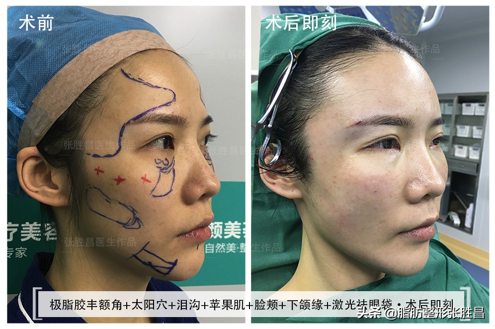 为什么脂肪填充要全麻,为什么脂肪填充算是整容