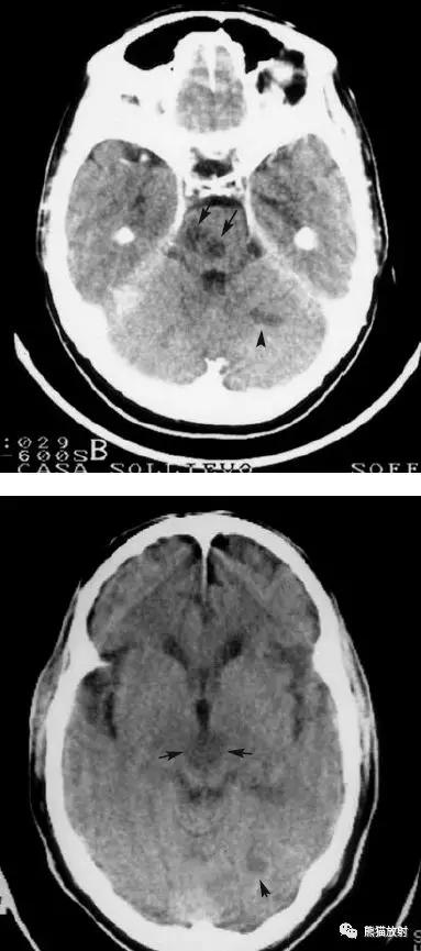 脑梗死丨演变、血供区域分布、CT表现