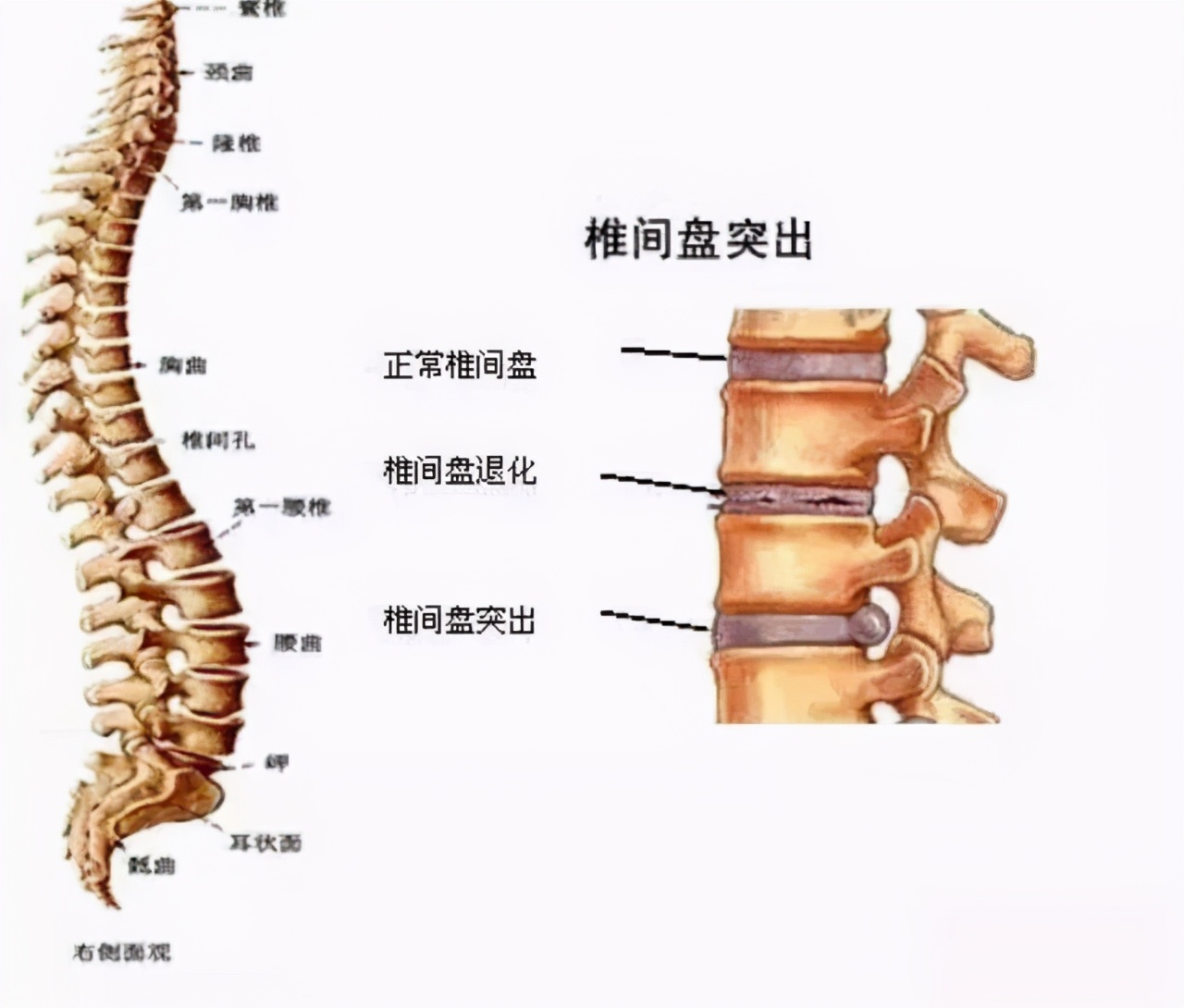 腰突坐骨神经痛最快的治疗方法,百年扁氏老黑膏治疗腰突有效吗