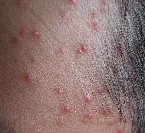 乙肝患者皮肤发黄还意味着什么,乙肝患者皮肤出现红点