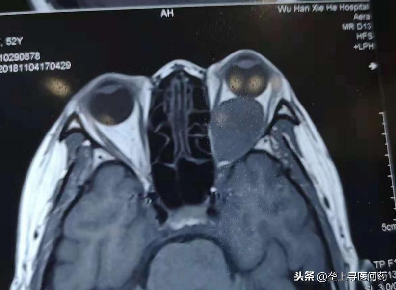 协和医院眼睛激光手术,协和医院眼科最新技术