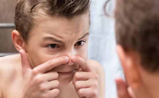 鼻翼上的黑头怎么去除,鼻翼旁边的黑头怎么去除