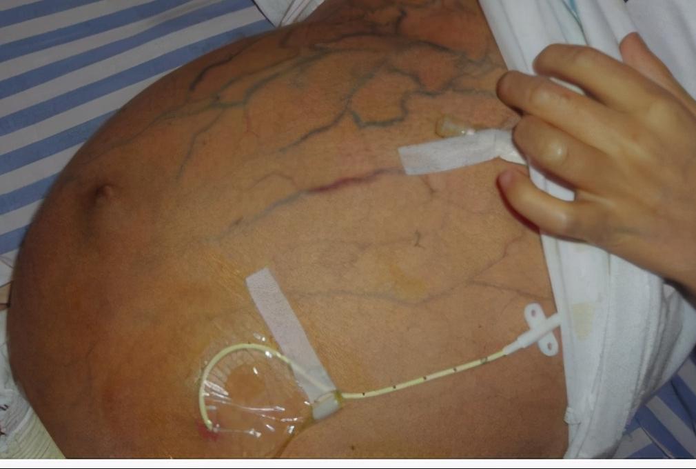 乙肝dna病毒量高可以打新冠疫苗吗,乙肝转氨酶高140可以打新冠疫苗吗