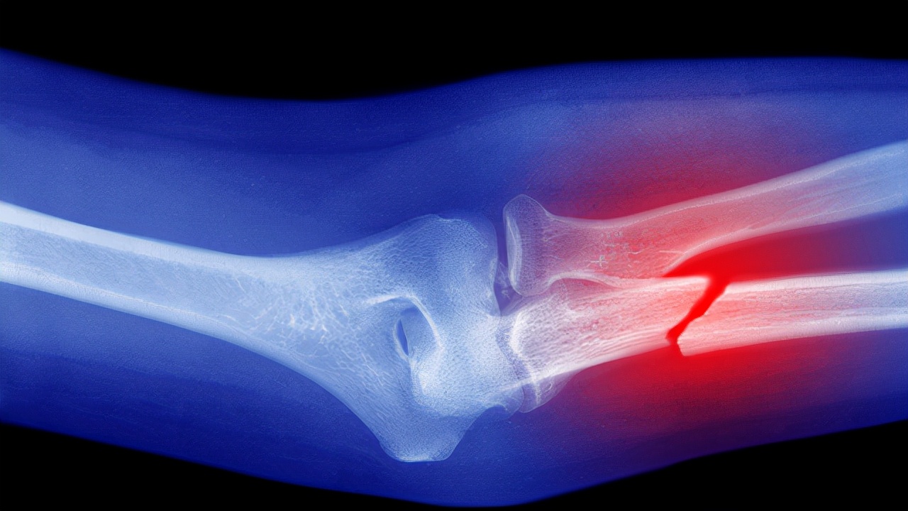 骨质疏松手腕骨折怎么补钙,骨质疏松骨折吃什么能恢复快