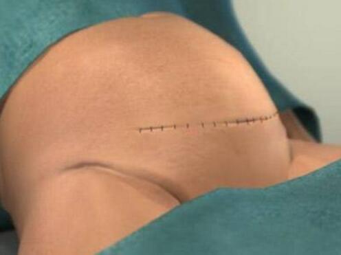 剖腹产是美容线好还是拆线的好？区别有4点，孕妇早知道早避免