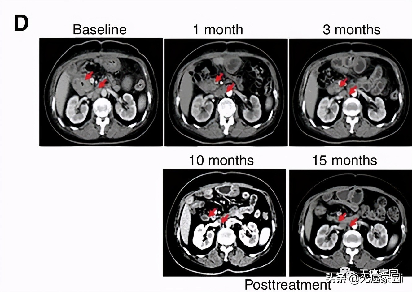 中国cart细胞疗法上市,car-t新药进展