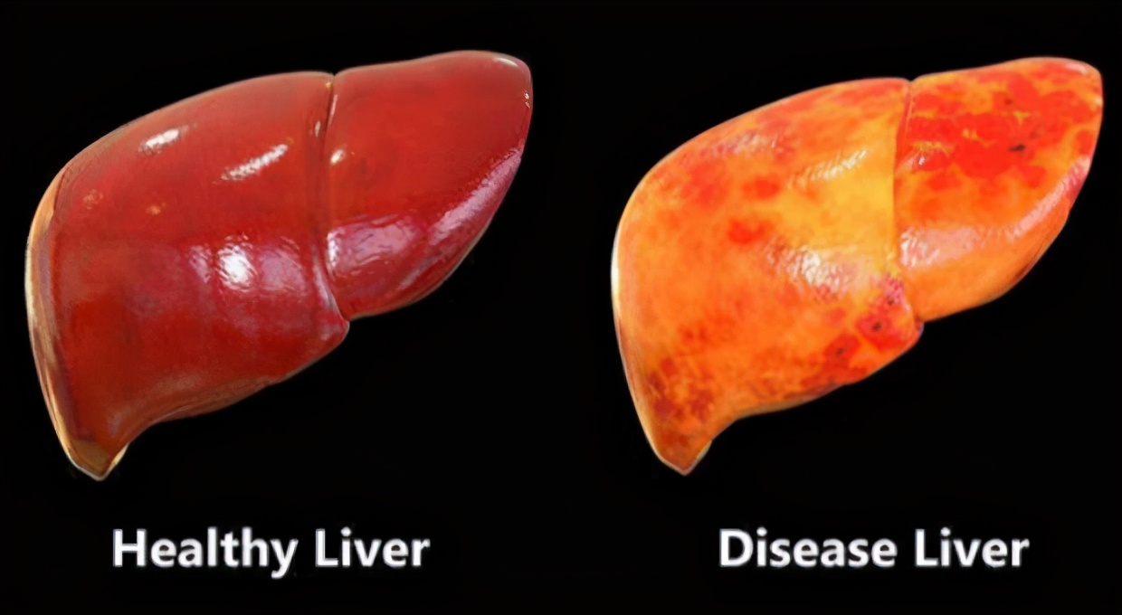 轻视「轻度脂肪肝」的人，后来怎么样了？科学家为此研究51年