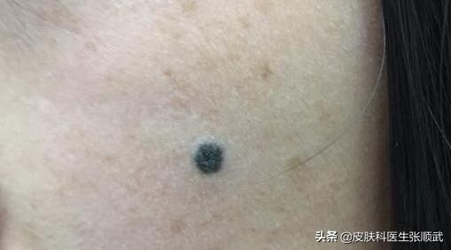 生下来特别小的痣长大变得很大,生下来就有的痣越长越大