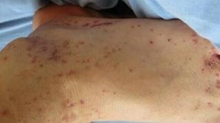 过敏性紫癜常见类型及鉴别,过敏性紫癜最常见的类型是什么