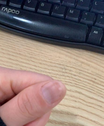 分享乙肝治愈路,分享养生知识辨别灰指甲