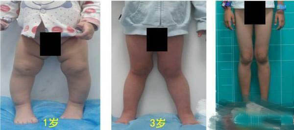 父母腿都不是很直孩子怎么办,感觉自己孩子腿不直