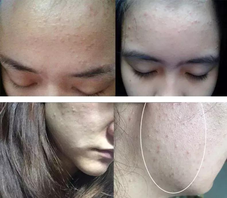 涂防晒霜爆皮,涂防晒霜就起疹子