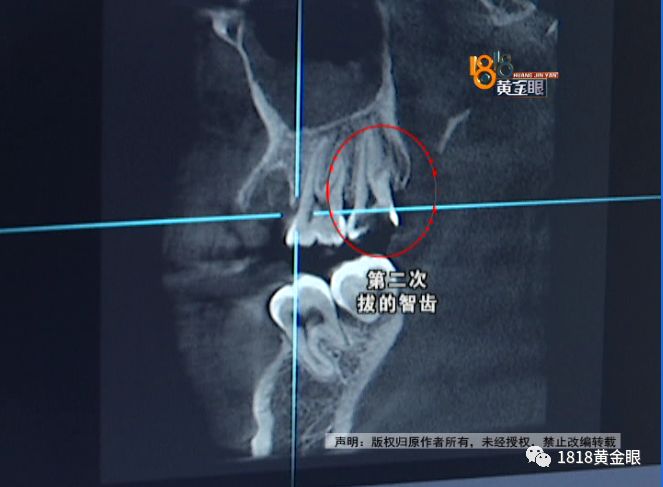 两次拔牙中间需要间隔多久,两次拔牙必须是一个医生吗
