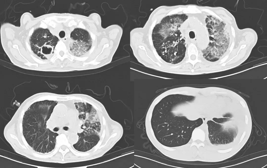不明原因胸腔积液案例,胸腔积液病例