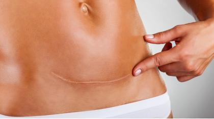 大多数孕妈的疑惑：前置胎盘是什么？为什么会出现？