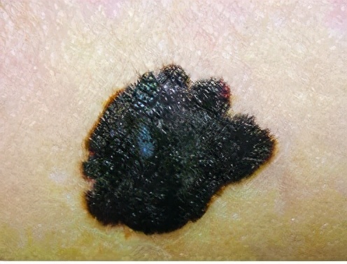 身上长了小黑点是不是癌症,头上有个黑痣是黑色素瘤吗