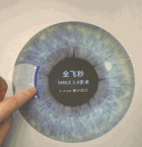 眼睛近视了做手术有什么注意事项,眼睛近视做激光手术需要注意什么