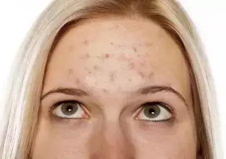 为什么一到换季就爱长痘,为什么一到换季皮肤就长痒痘