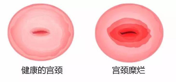 宫颈糜烂出血是很严重的病吗,女人宫颈糜烂可怕吗