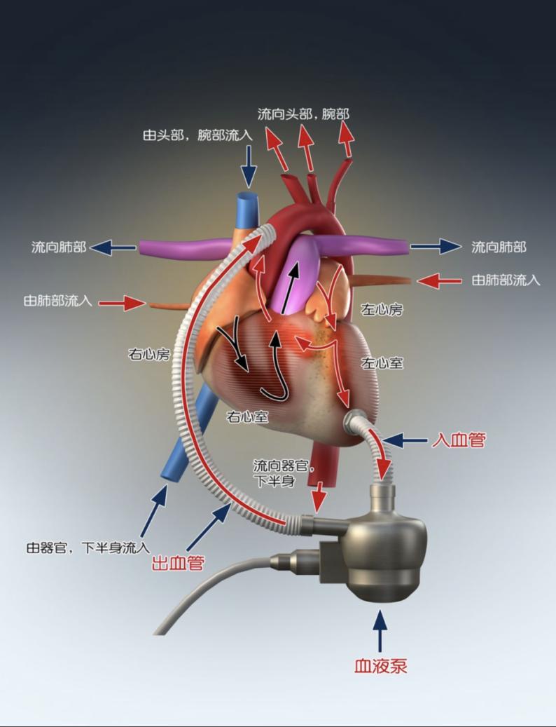 自主研发人工心脏植入成功,植入式人工心脏