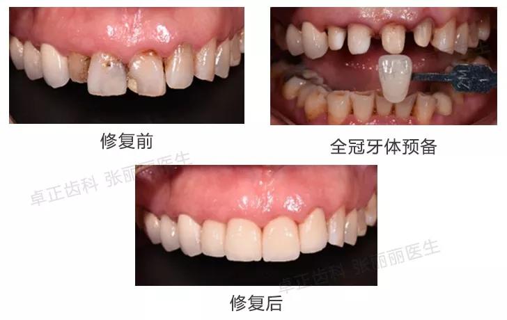 牙齿楔状缺损修复图片,牙齿楔状缺损修复大概多少钱