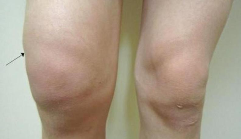 膝盖有滑膜炎要紧吗,膝盖有滑膜炎怎么治疗