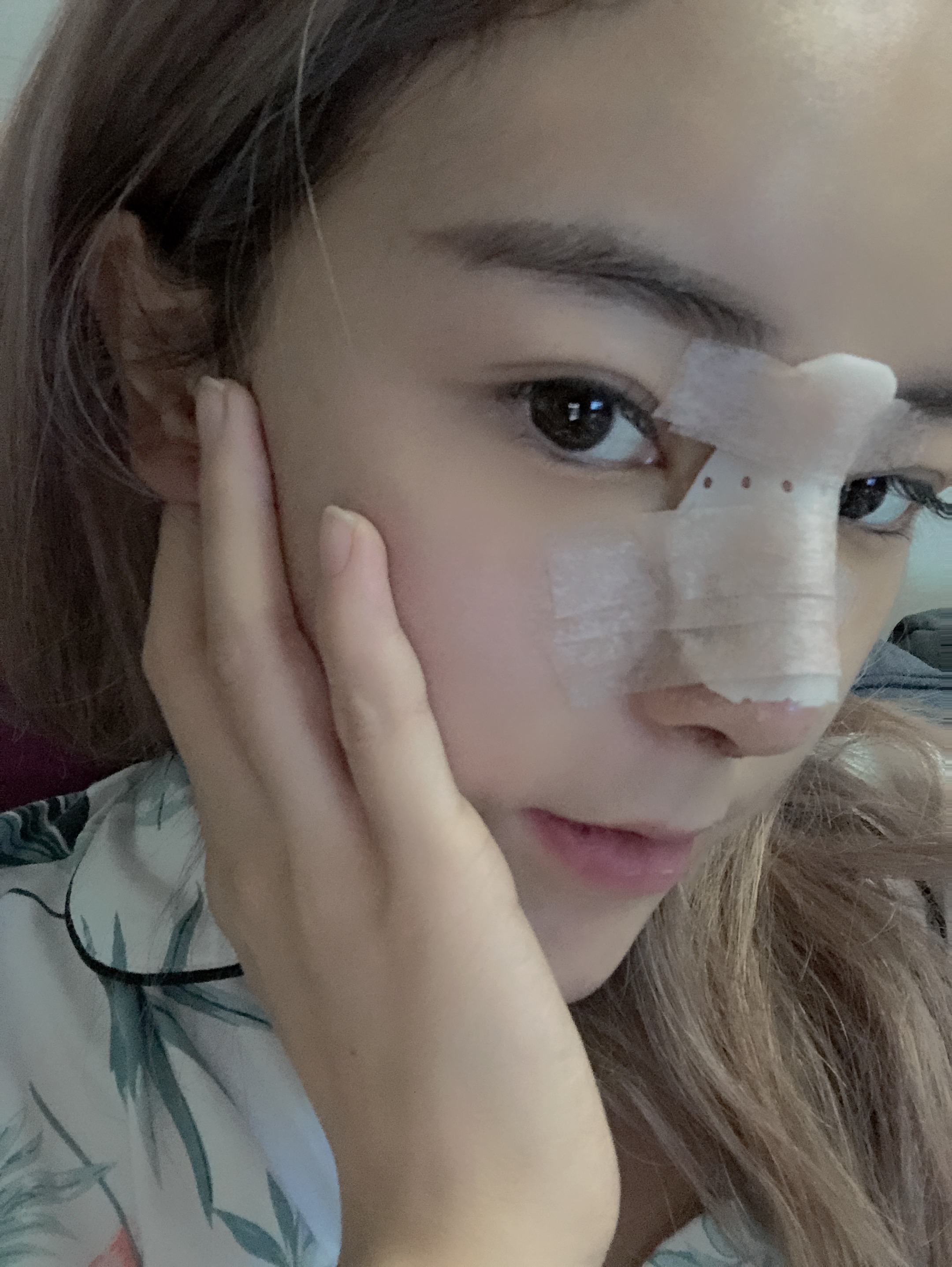 肋骨隆鼻最快的恢复方法,肋骨隆鼻即刻效果